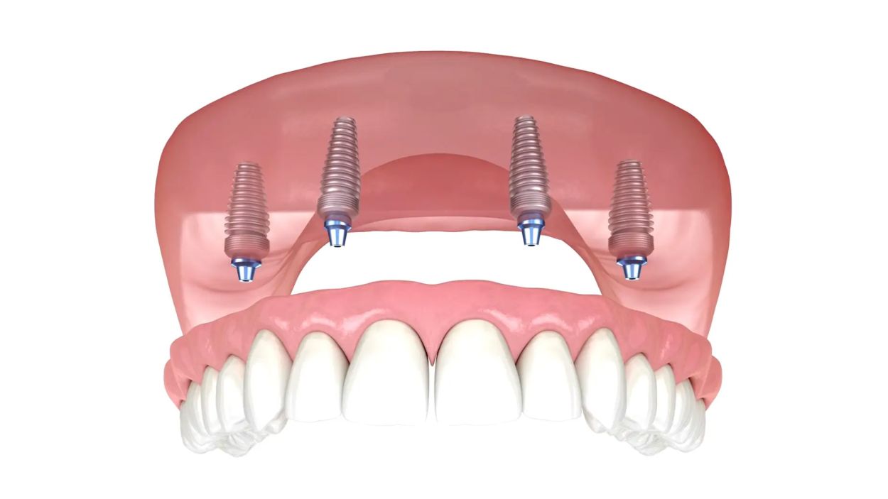 Implant-supported overdentures in North Yorkshire